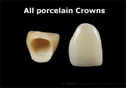 porcelain_crowns_sm.jpg